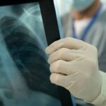 Côte fêlée : combien de temps dure la douleur et quels traitements envisager ?