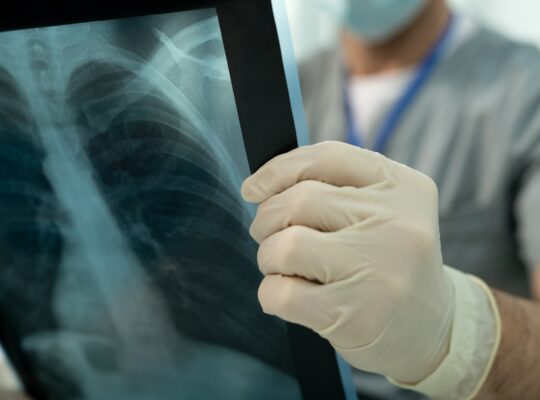 Doctor analyzing lung x-ray image