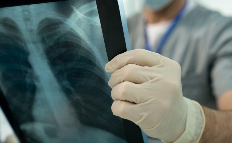 Doctor analyzing lung x-ray image
