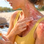 Les erreurs à éviter lors de l&rsquo;application d&rsquo;une crème pour une allergie au soleil